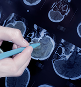 室管膜瘤二级是良性还是恶性？室管膜瘤该怎样治疗？