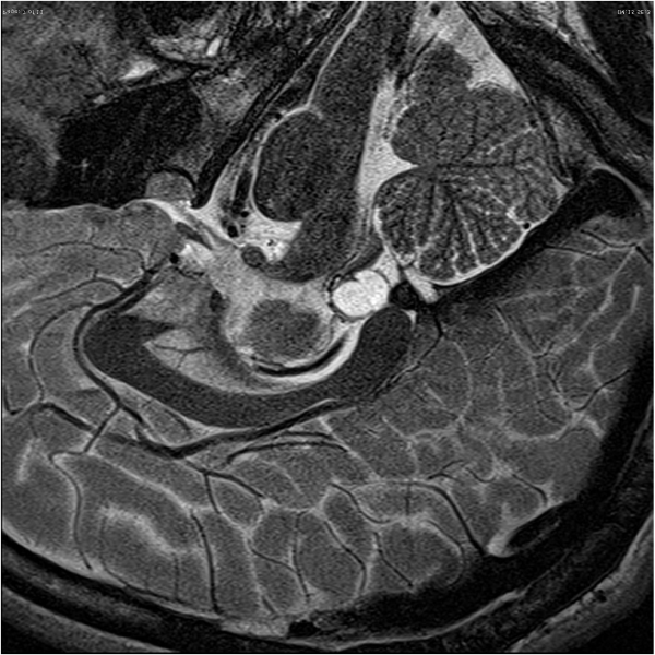 松果体瘤恶性能活多久？
