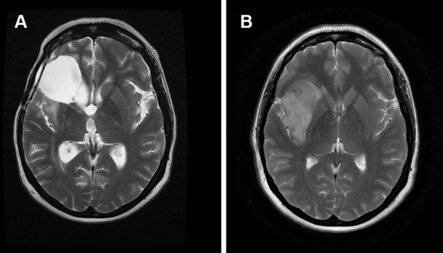 脑胶质瘤是什么病？脑胶质瘤常见的类型