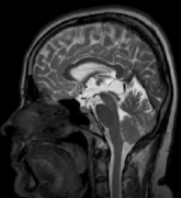 松果体肿瘤一般多大？松果体瘤是良性还是恶性？