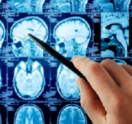 脑海绵状血管瘤是怎么引起的？需要手术切除吗？