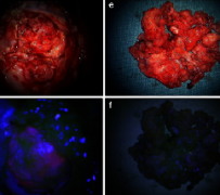 脑膜瘤是大手术吗？5-ALA荧光导向切除颅内脑膜瘤的现状