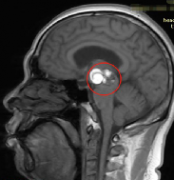 脑海绵状血管瘤严重吗？不做手术肿瘤能自愈吗？
