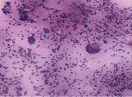 松果体肿瘤是癌症吗？5年生存率是多少？