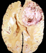 胶质瘤复发后还有多久生存期？胶质母细胞瘤复发几率？