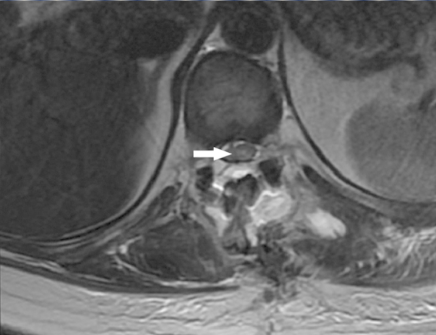 脊髓脑膜瘤术后后遗症有哪些？
