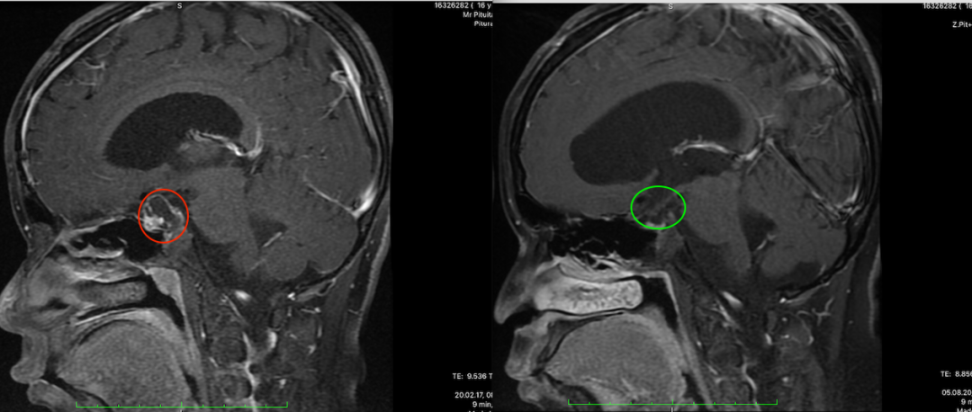 脑瘤案例图片