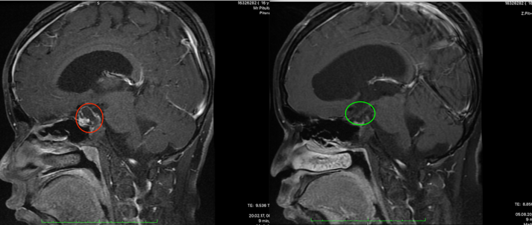 颅咽管瘤16年3次复发，癫痫、发育迟滞，再次手术还能挽救吗？