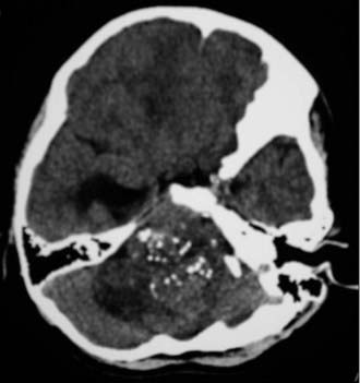 室管膜瘤能治愈吗？成人颅内室管膜瘤如何治疗？