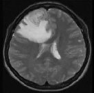 良性脑瘤手术后能活多久？