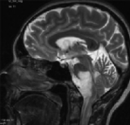 脑干胶质瘤是绝症吗？脑干胶质瘤IDH1突变案例报告