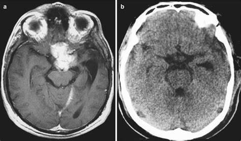 嗅沟脑膜瘤严重吗？