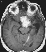 嗅沟脑膜瘤严重吗？
