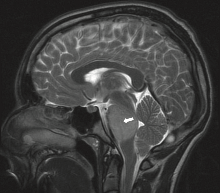 小儿DIPG真的治疗无望吗？多国家、多学科海外专家联合支招
