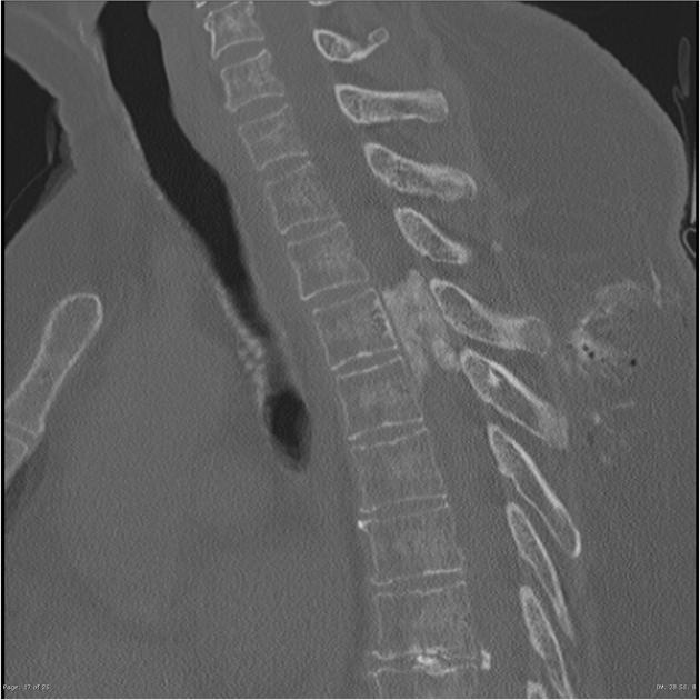 脊柱脑膜瘤钙化严重吗？