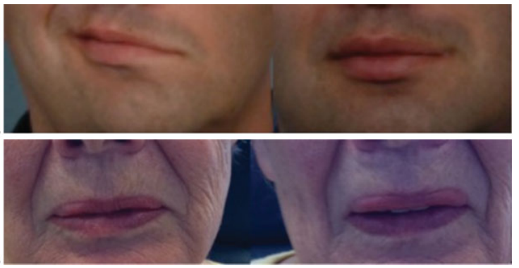 听神经瘤手术后面瘫