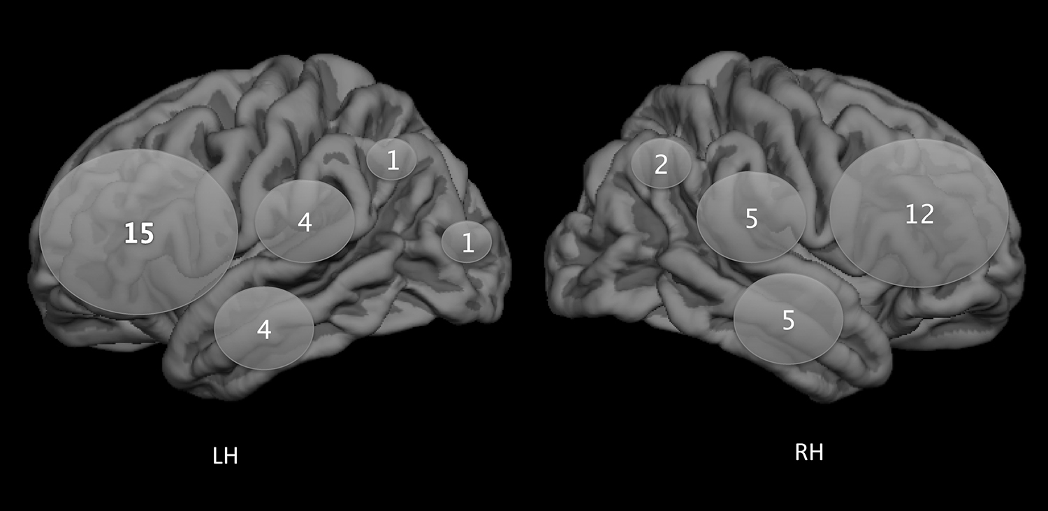 低级别胶质瘤术后癫痫