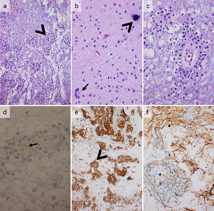 7岁菊形团形成性胶质神经元肿瘤(RGNT)患者案例报告一则