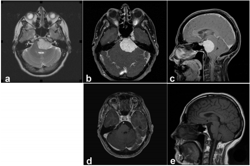 岩斜区脑膜瘤案例