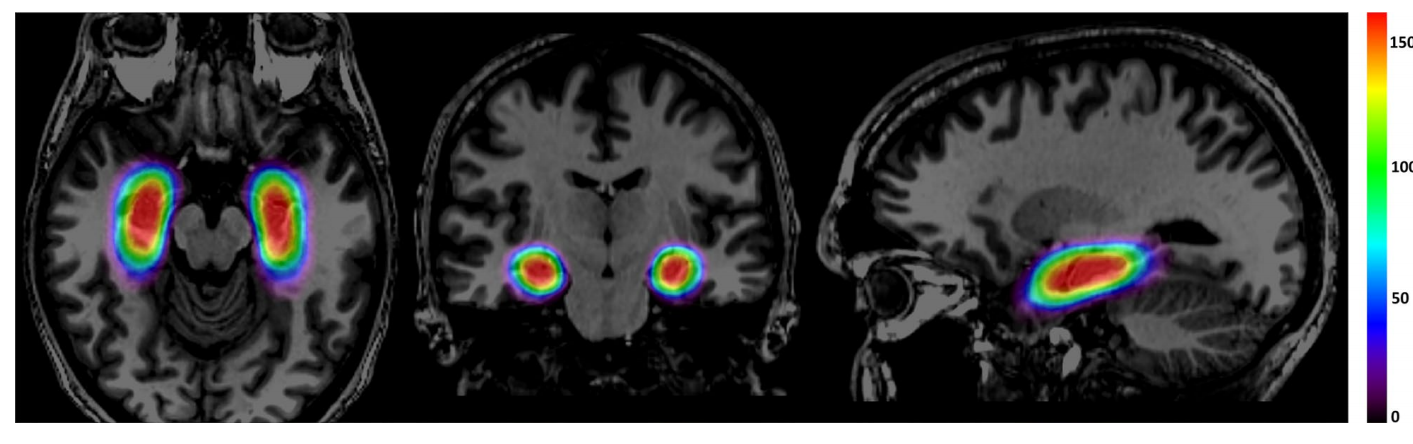 颞中叶癫痫能治好吗？国际前沿技术LITT治癫痫效果好吗？