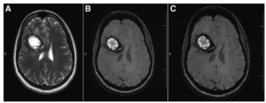 脑海绵状血管瘤