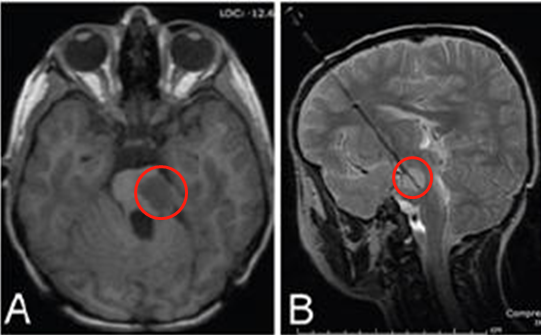 <a href='/qianyan/litt/' target='_blank'><u>LITT</u></a>治疗脑瘤