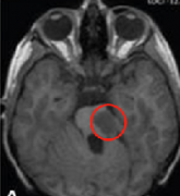 恶性脑瘤术后复发，LITT避免二次开颅、术后次日出院、1年半未复发