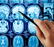 良性脑瘤手术后遗症会有哪些？怎么避免？