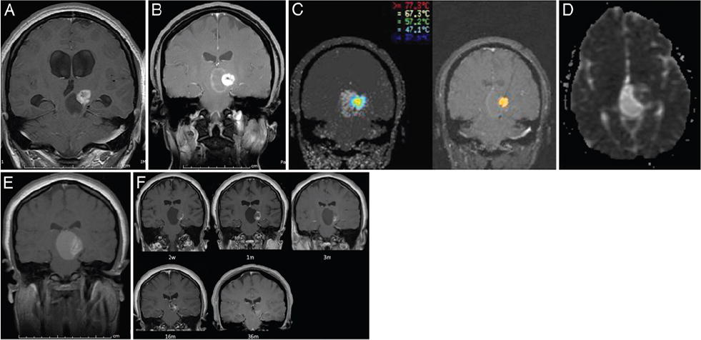 LITT治疗儿童神经<a href='/bingzhong/jiaozhiliu/' target='_blank'><u>胶质瘤</u></a>案例