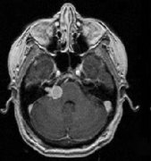 问：听神经瘤能自愈吗？听神经瘤的保守治疗有用吗？