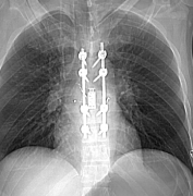 脊柱血管瘤患者在巴罗神经学研究所接受改变生活的治疗
