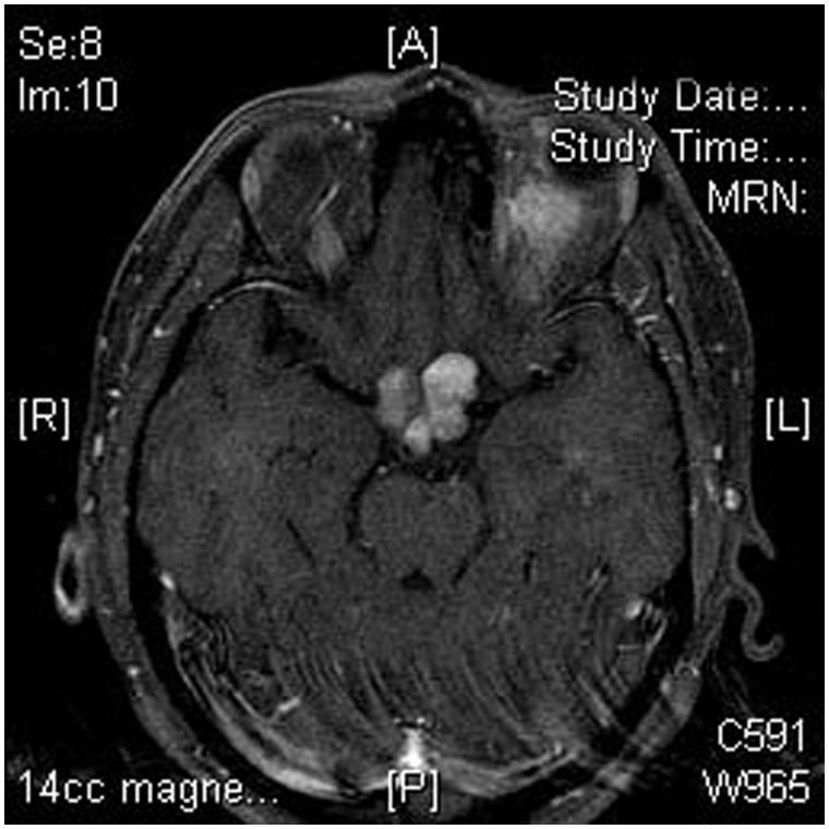 成人侵袭性低级别视神经胶质瘤好治吗？