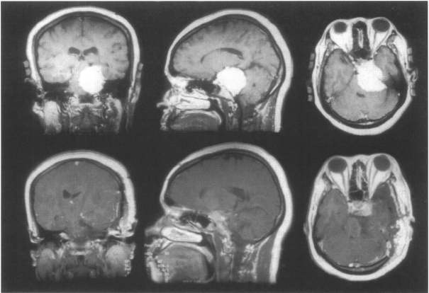 巨大岩斜脑膜瘤合并假性延髓麻痹案例报告一则