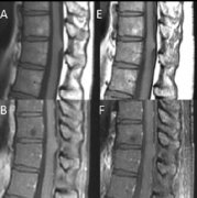 脊髓胶质瘤手术多久可以完全康复？