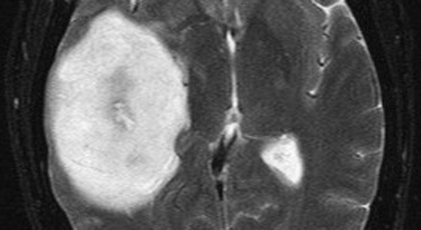 多发性<a href='/bingzhong/jzmxbl/' target='_blank'><u>胶质母细胞瘤</u></a>