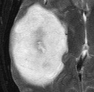 INC美国Mitchel Berger教授：新诊断胶质母细胞瘤的切除阈值范围