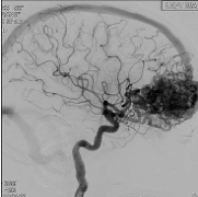 儿科动静脉畸形AVM干预的有利长期结果