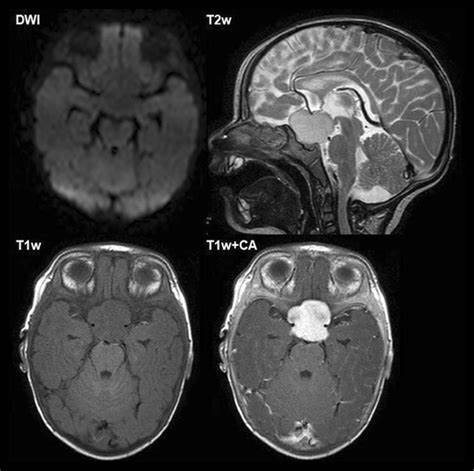 星形细胞瘤能活几年？