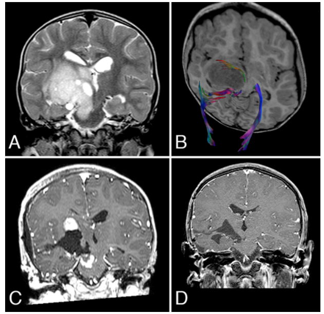 小儿丘脑肿瘤的更佳外科治疗方法是哪种？