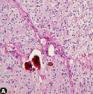 松果体区域肿瘤有哪些类型?有什么临床表现？