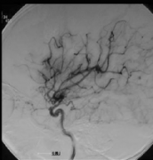 国际专家主治病例：早期手术的确利于小儿烟雾病的治疗