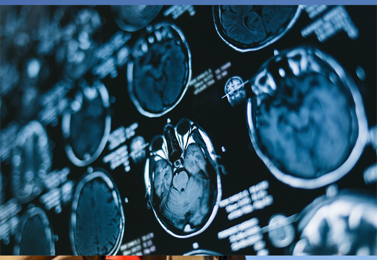 消防员的听神经瘤治疗故事