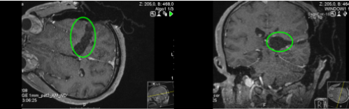 <a href='/jibing/naojiaozhiliu/1548.html' target='_blank'><u>胶质瘤治疗</u></a>