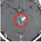 质地、⾎供、侵袭性不同，谈良、恶性胶质细胞瘤的手术策略
