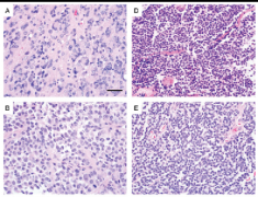 松果体肿瘤的组织病理学确定其形态亚型和预后因素