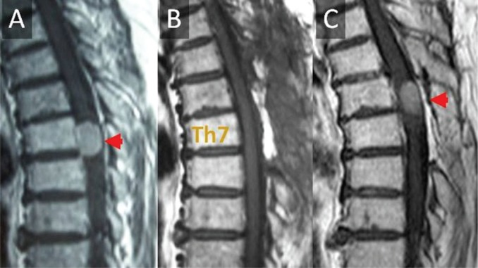 辛普森一级切除在脊柱脑膜瘤中是必要的吗？