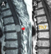 辛普森一级切除在脊柱脑膜瘤中是必要的吗？