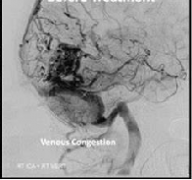 问：脑动静脉畸形栓塞有用吗？