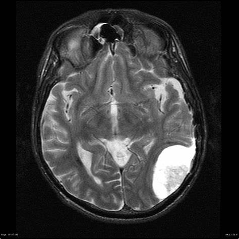幕上脑膜瘤癫痫发作能治好吗？