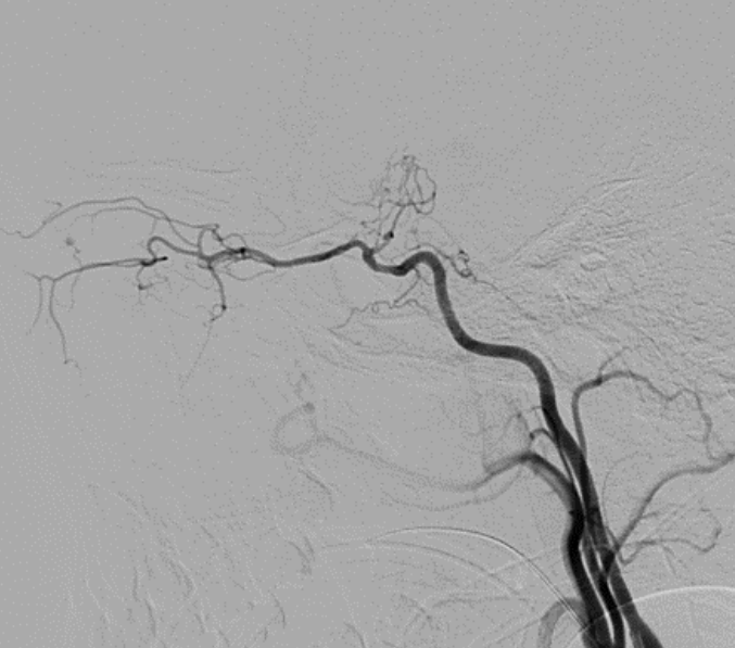 小儿烟雾病的治疗究竟何去何从？